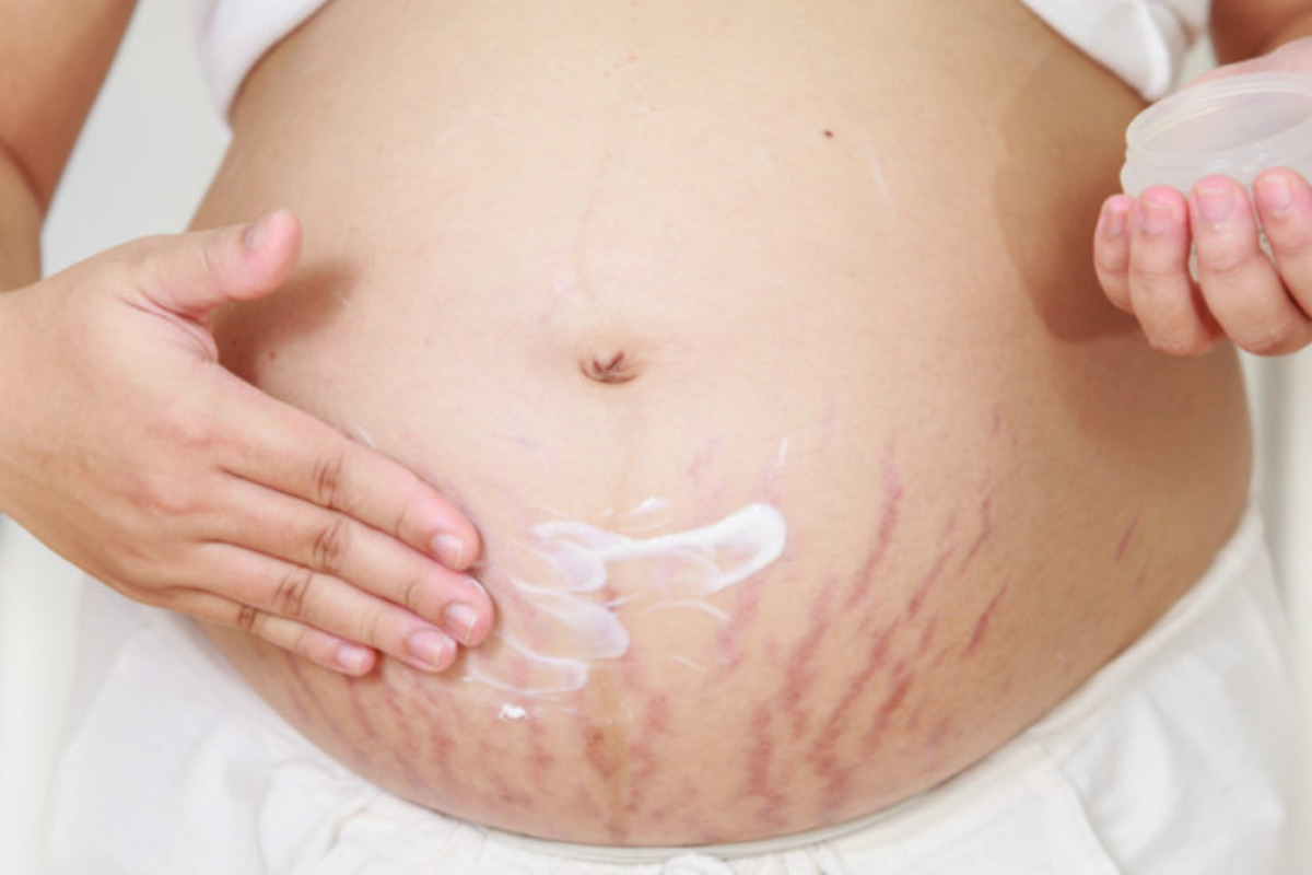 Creme Caseiro para Estrias